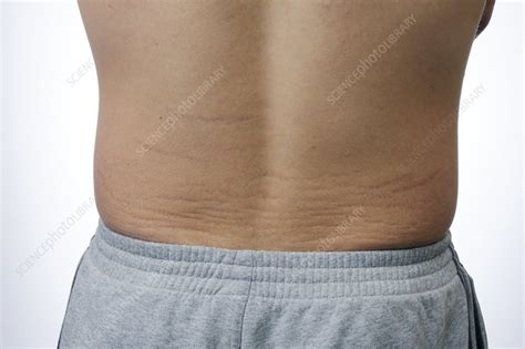 Skin Striae Lines On The Back Stock Image C0117576 Science