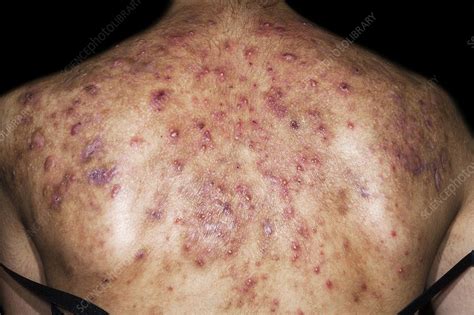 Cystic Acne Stock Image C0239331 Science Photo Library