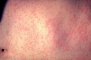 Measles morbilliform rash - dermRounds Dermatology Network