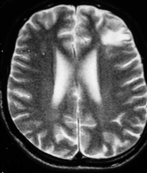 Case 5 Rm T2 Axial Showing A Subcortical White Matter Lesion In The
