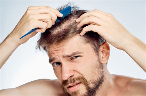 Common Signs Of Male Pattern Baldness In Men