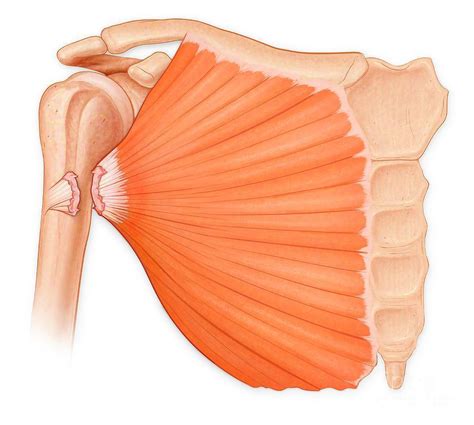 Pectoralis Tear How Chiropractic And Physical Therapy Can Aid In