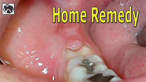 Swollen Gums From Wisdom Tooth Carfareme 2019 2020