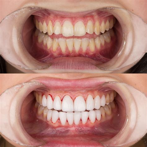 Before-After Pictures | DENTAGLOBAL. Dental Implants ...
