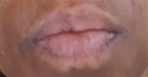 Skin Around Lips Is White Lipstutorial Org