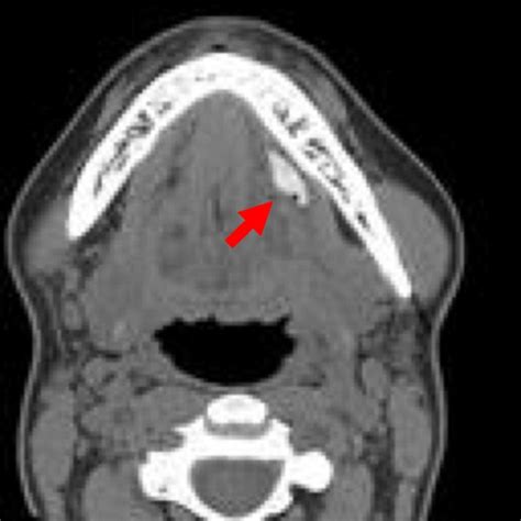 Plunging Ranula T2 Weighted Mri Showing Bilateral Plunging Ranulae