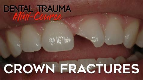 Dental Trauma Mini Course Part 4 Dental Trauma Guide Crown