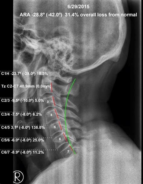 Lateral Cervical Radiograph 6292015 Alignment Shows Forward Head