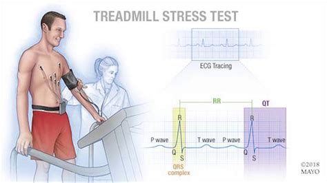Reference Tool For Cardiac Stress Test Mylifelasopa
