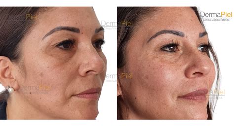 Antes Y Despues Pomulos 1 Dermapiel