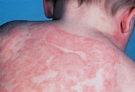 Picture Of Atopic Dermatitis Or Eczema
