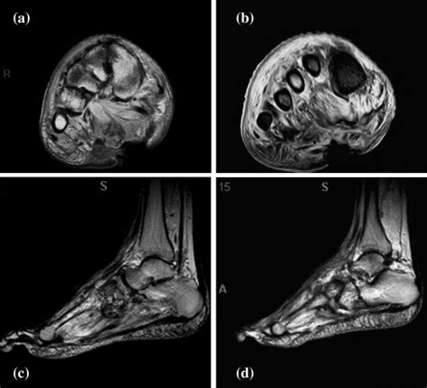 Abnormal Foot Mri Images