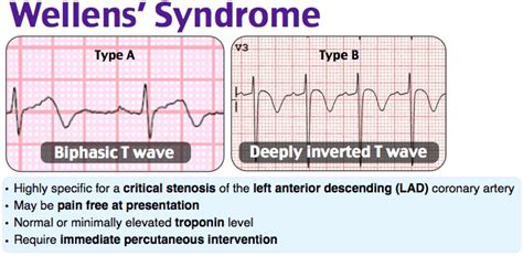 Wellens Syndrome Type A Biphasic T Wave Type Grepmed