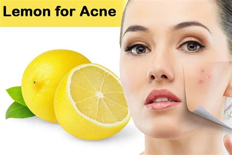 The advantage of drying the surface is that it helps remove the skin tags. Lemon Juice for Acne Scars: Is it Good for You - Alt ...