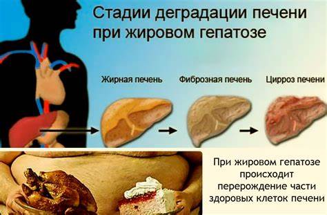 Диета и лечение при гепатозе Жировая Дистрофия Печени Причины И Диета — Похудение Диета Правильное Жировая Дистрофия Печени Причины И Диета — Похудение Диета Правильное Диета и лечение при гепатозе