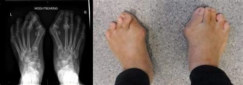 Bunion Hallux Valgus1 Foot Focus Podiatry Perth Podiatrists