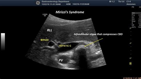 Mirizzi Syndrome 1 Image EFSUMB