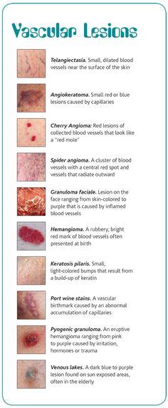 Image Result For Skin Lesion Guide Dermatology Nurse Home Health