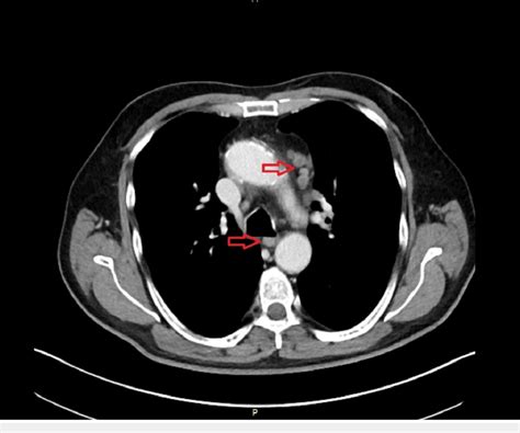 Ct Scan The Image Shows Suspect Mediastinal Lymph Nodes Download