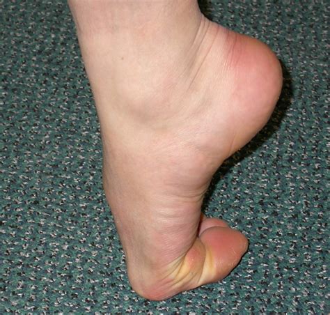 Hallux Rigidus Big Toe Arthritis The Foot And Ankle Clinic