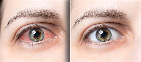 Red Eyes List Of Common Causes And Remedies Lentiamo