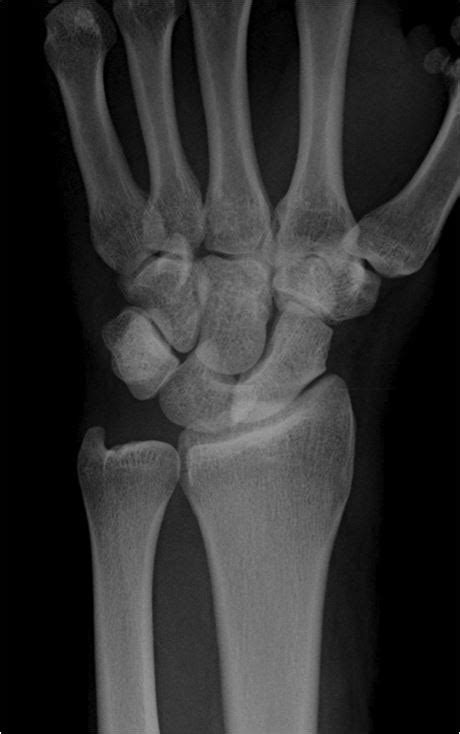 Dislocated Wrist X Ray