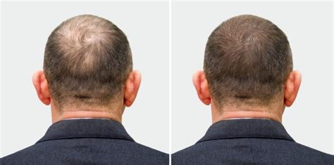 How Much Does Scalp Micropigmentation Cost Smp