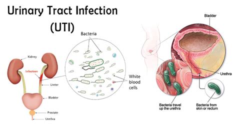 Uti Or Urinary Track Infaction Homeopathic Treatment In Dehradun