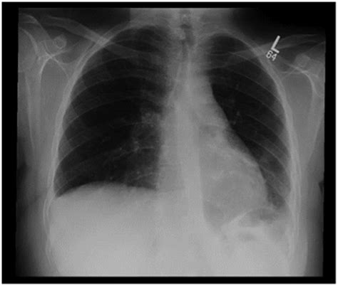Normal Chest X Ray 18 Months Post Repair Download Scientific Diagram