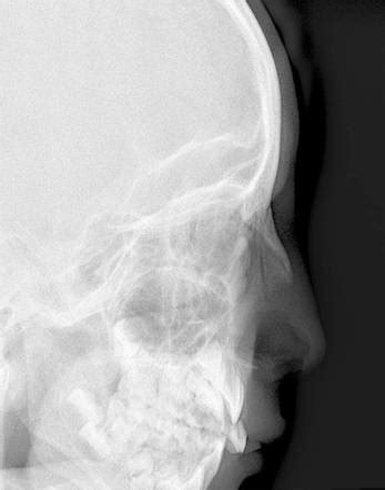 Want to review the anatomy of the carpal bones? Normal nasal bone radiograph (6-year-old) | Image ...