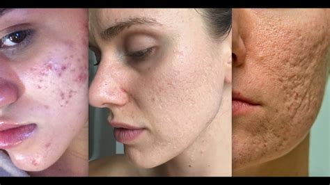 7 Best Acne Scar Treatments Recommended By Dermatologists Available Ideas