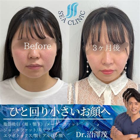 3d脂肪吸引で立体的な小顔が叶う。 Sea Clinic −シークリニック 銀座― 理想を叶える小顔治療