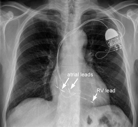 Pacemaker Lead Induced Severe Tricuspid Valve Stenosis Circulation