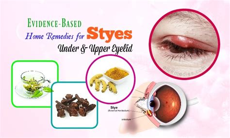 25 Evidence Based Home Remedies For Styes Under And Upper Eyelid