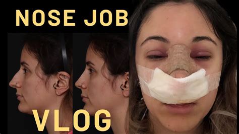 Nose Job Vlog Experience Recovery Before And After Rhinoplasty