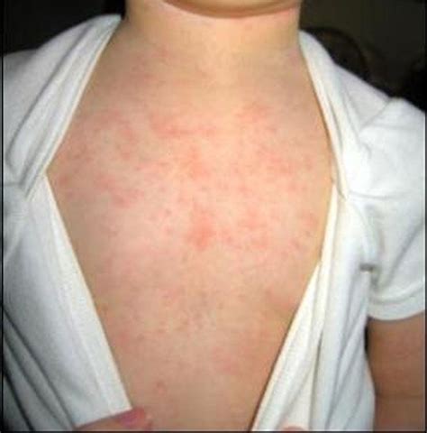 Baby Rash Pictures Causes Treatments Mommyhood101