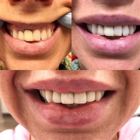 Smile Gallery - Before and After - Lakeland, TN - Cordova, TN - Memphis