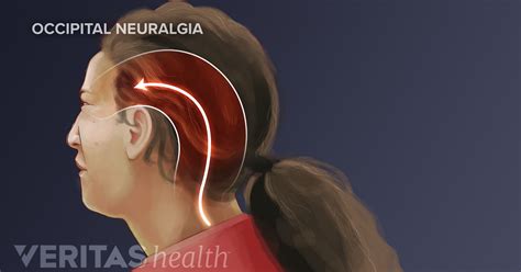 Headache At Base Of Skull Headache Behind The Ear Signs Causes And