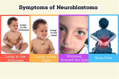 Neuroblastoma In Children Stages Symptoms Causes Treatment