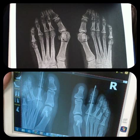 Before And After X Rays Double Bunionectomy On 1st And 5th Toes Double