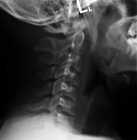 Lateral Cervical Spine X Ray Lateral Plain Film Obtain Open I