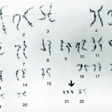 Karyotype Of Trisomy 21 Karyotype The Arrow Indicates Extra Chromosome 21 Download