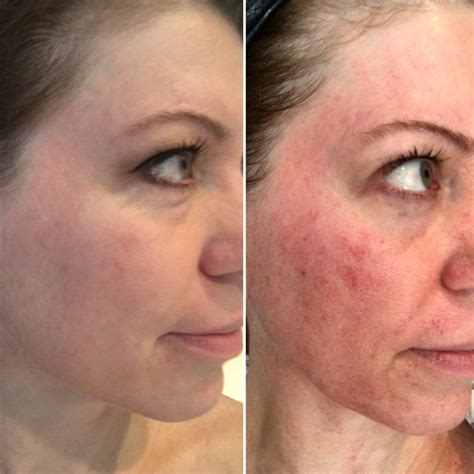 My Experience And Before And After Photos With Microdermabrasion