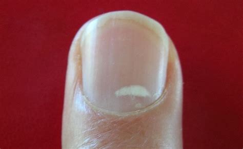 What Causes Persistent White Spots On Nails Naildesigncode