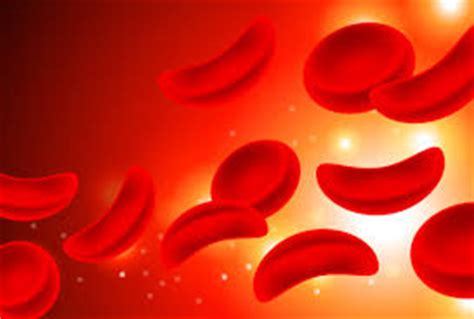 People who have sickle cell disease always have some degree of anemia (often causing fatigue, weakness, and paleness) and may have mild jaundice. Sickle Cell Anemia