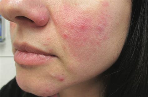Rosacea Best Treatment That You Need To Know The Kitchensurvival