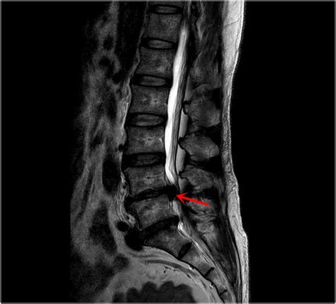 Mri Imaging Of The Lumbar Spine Demonstrating A Discal Cyst With