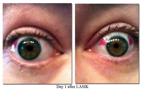 My Lasik Eye Surgery Experience The Single Founder Blog