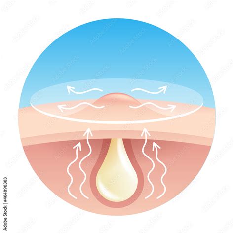 Acne Pimple Patch Pus Absorbing Stock Vector Adobe Stock