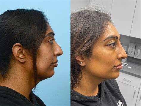 Non Surgical Rhinoplasty Before And After Dr Jeffrey Wise